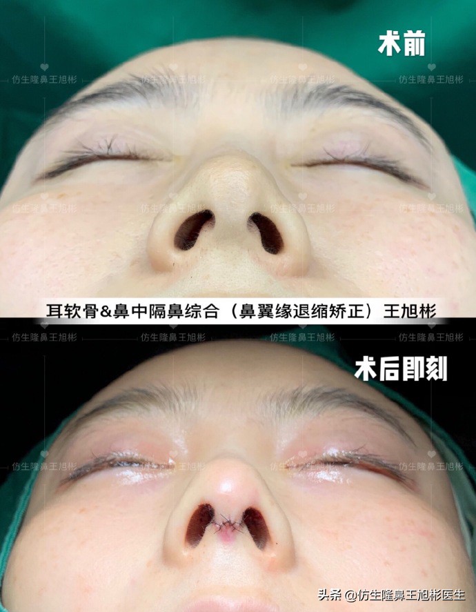 王旭彬:朝天鼻、露鼻孔,模特菲菲短鼻矫正手术后1.5个月