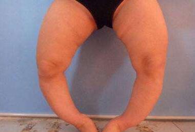 o型腿和骨关节炎有关系吗,骨关节炎怎么发展成x型腿