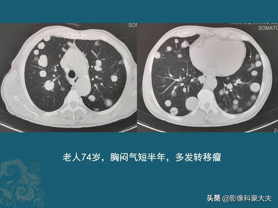 查出癌症后别绝望,癌症保守治疗的最新治疗方法