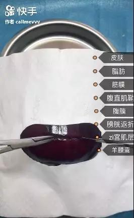 香蕉割包皮,洋葱剖腹产?这是我见过最秀的医生