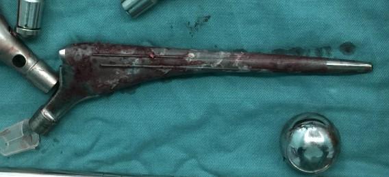 髋部骨折危害大老年人摔伤要重视,髋部骨折的最简单方法