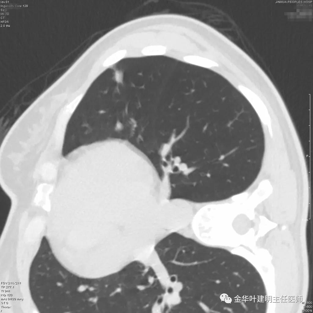 叶建明谈肺结节:一招分辨隐球菌性肉芽肿与肺癌