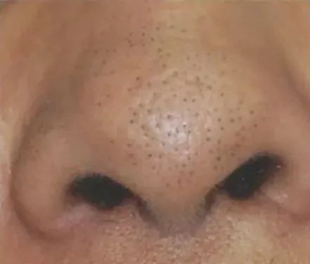 顽固黑头怎么去除最有效,祛除黑头最有效的方法