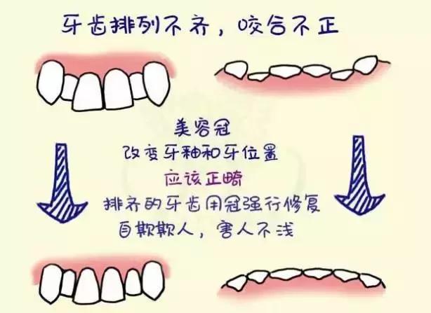 前牙磕掉了一块怎么办？#葉子口腔科普#