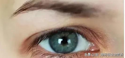 纳米无痕埋线双眼皮需不需要拆线,纳米无痕双眼皮动画操作过程视频