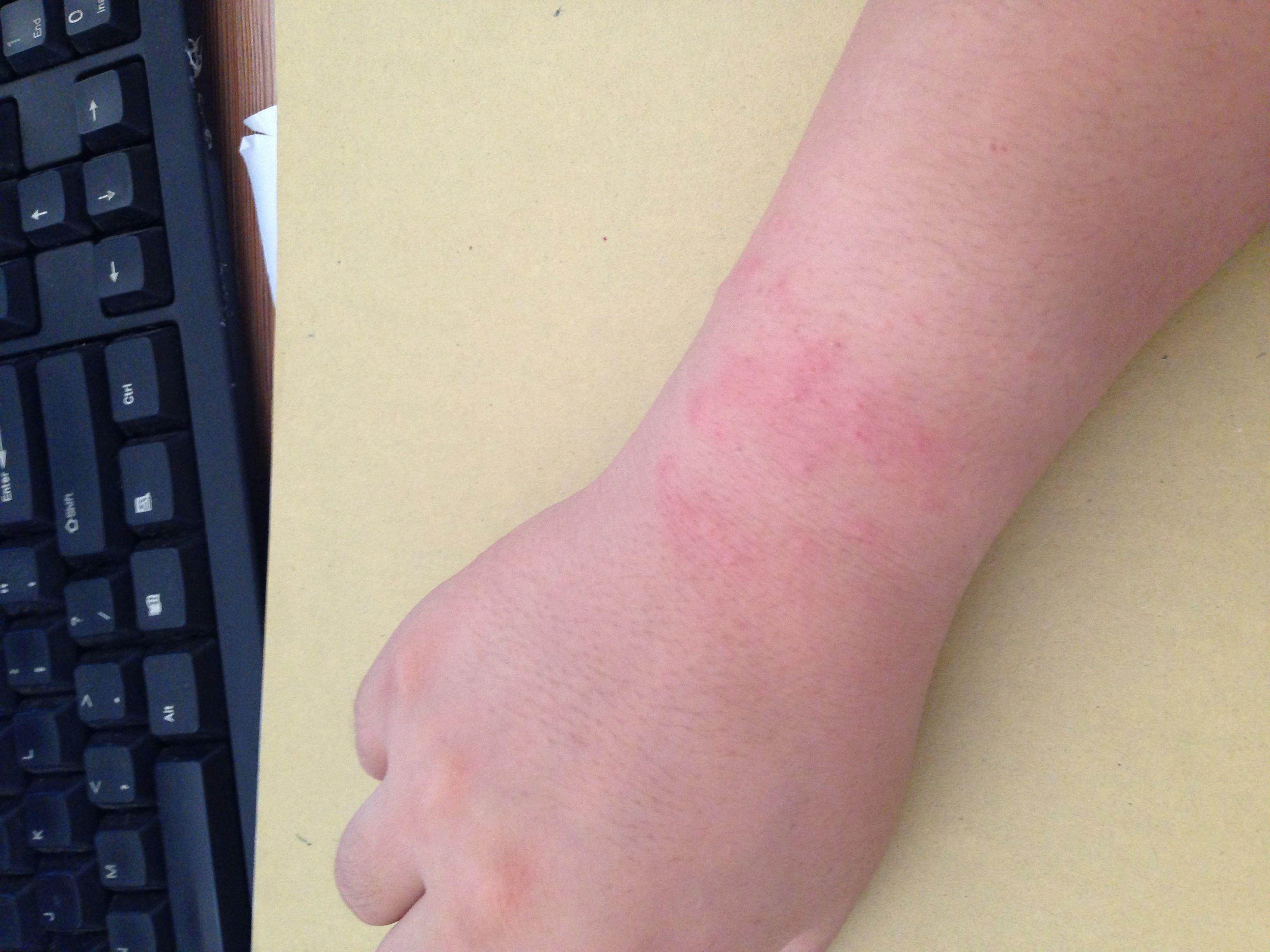 3岁宝宝上厕所喊“尿疼”，宝妈一看，赶紧带孩子去医院