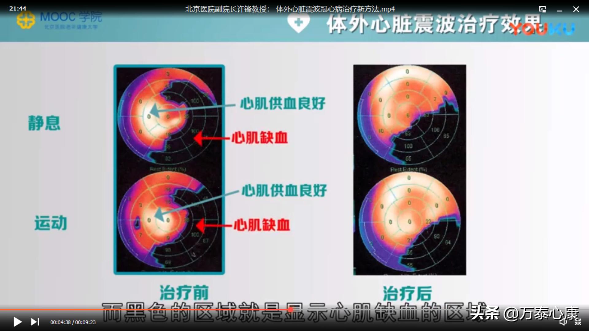 北京医院许锋医生,冠心病体外震波疗法