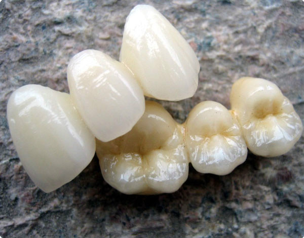 各种假牙价格一览表,假牙十大品牌价格表