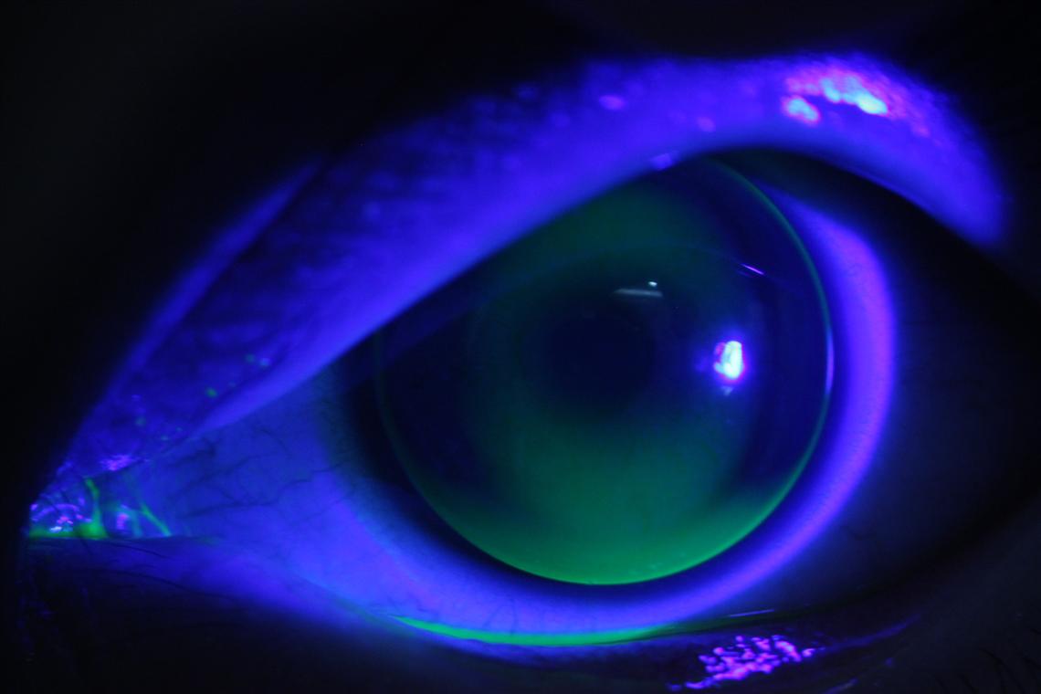 角膜散光大者一定不能配戴角膜塑形镜么？