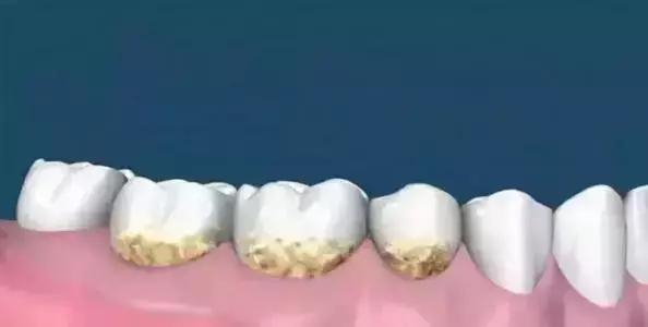 一口黄牙能洗白吗,一口黄牙毁了一张脸