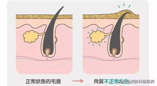 鸡皮肤太丑怎么办图片,鸡皮肤如何改善最有效