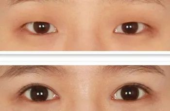 开眼角真的能变漂亮吗,关于开眼角你都了解什么