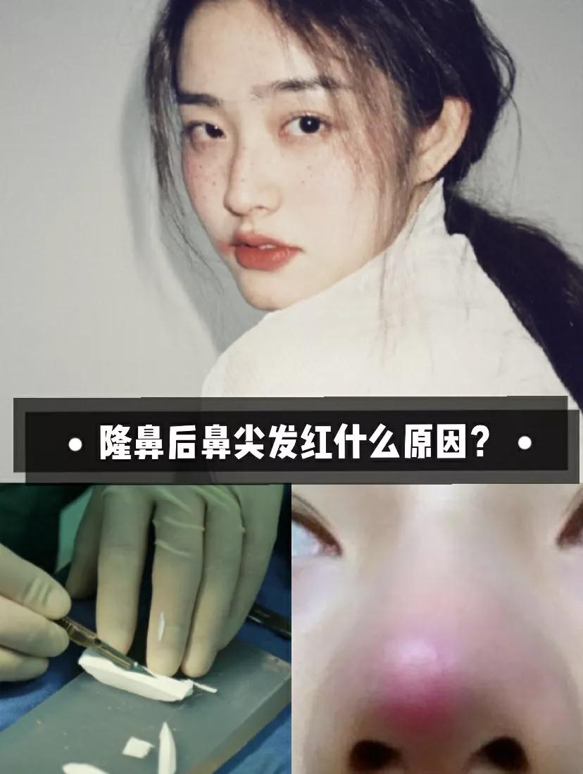 假体隆鼻后5天鼻尖发红,假体隆鼻三年后鼻尖发红