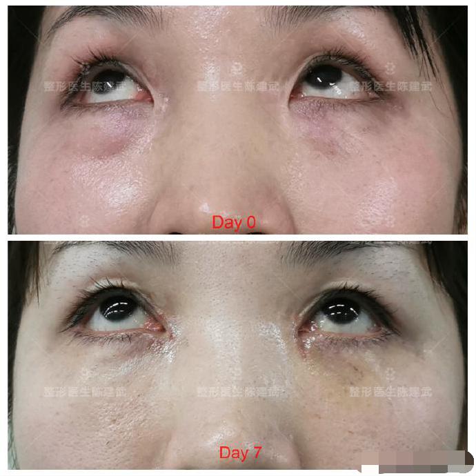 去眼袋泪沟医美方法,想了解一下去眼袋的最佳方法