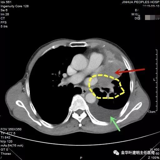 肺癌伴胸腔积液伴膨胀不全,肺癌晚期转移到肝脏引起腹腔积液