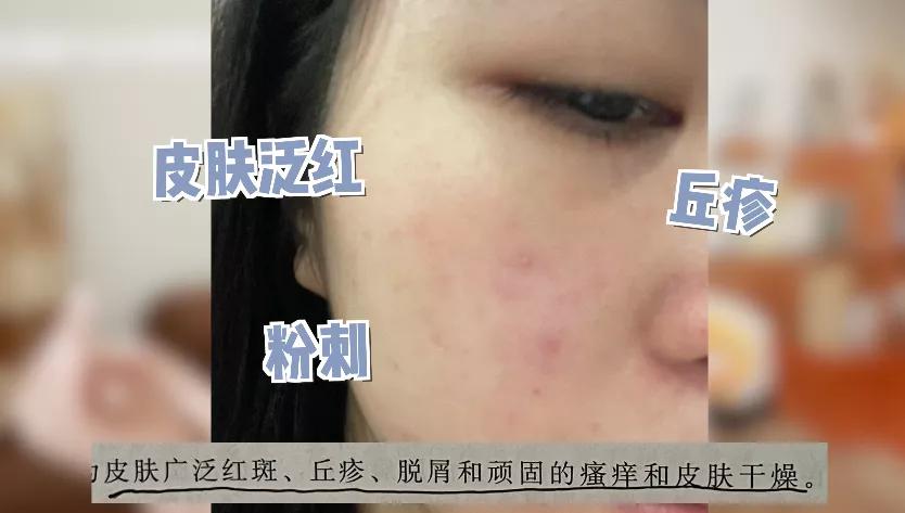 抗炎祛红痘痘,抗炎杀菌药膏痘痘