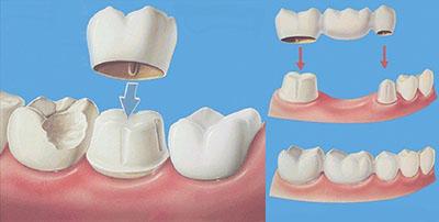 没有蛀牙为什么牙齿会有洞,牙蛀牙痛怎么办
