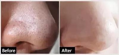 哪种果酸治闭口最好用,什么果酸对闭口有用