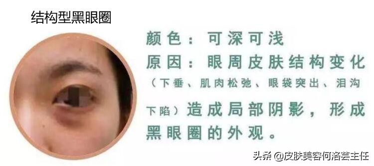 熬夜怎么快速去除黑眼圈,熬夜怎么消除黑眼圈学生党