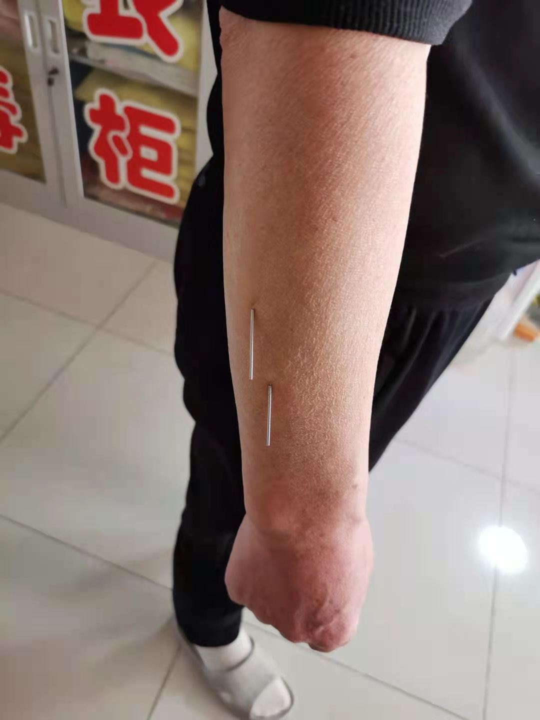 针灸治疗颈肩腰腿痛,针灸治疗颈肩腰腿痛的可行性分析