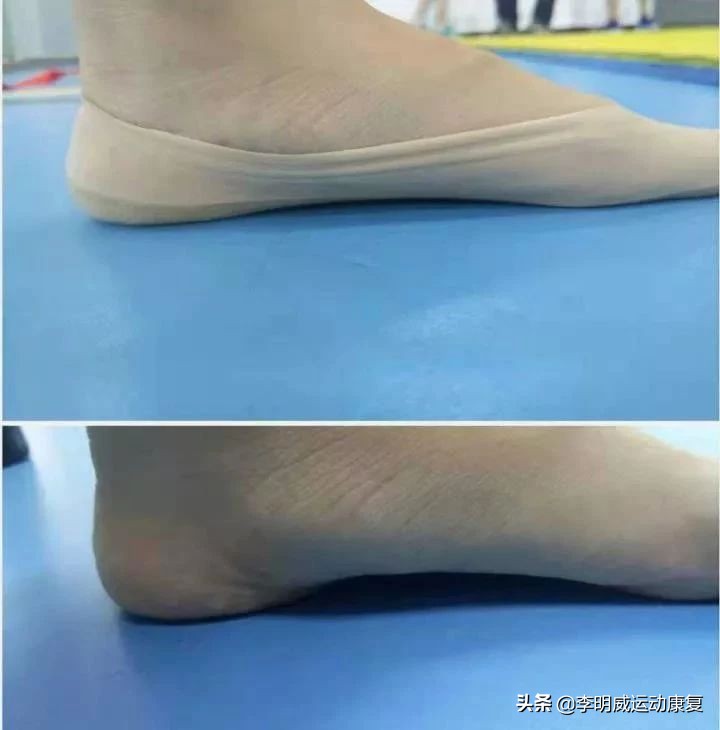 如何纠正宝宝不吃母乳,如何纠正足外翻的跑步姿势