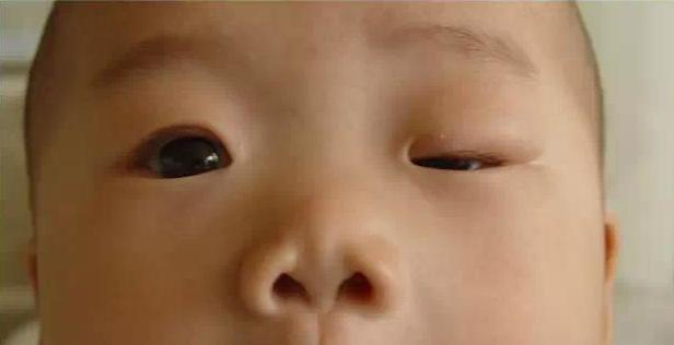 小儿推拿治疗上眼睑下垂,儿童推拿眼睛的正确方法