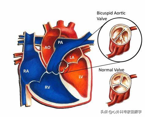 胸主动脉瘤最常见的护理措施,胸主动脉疾病