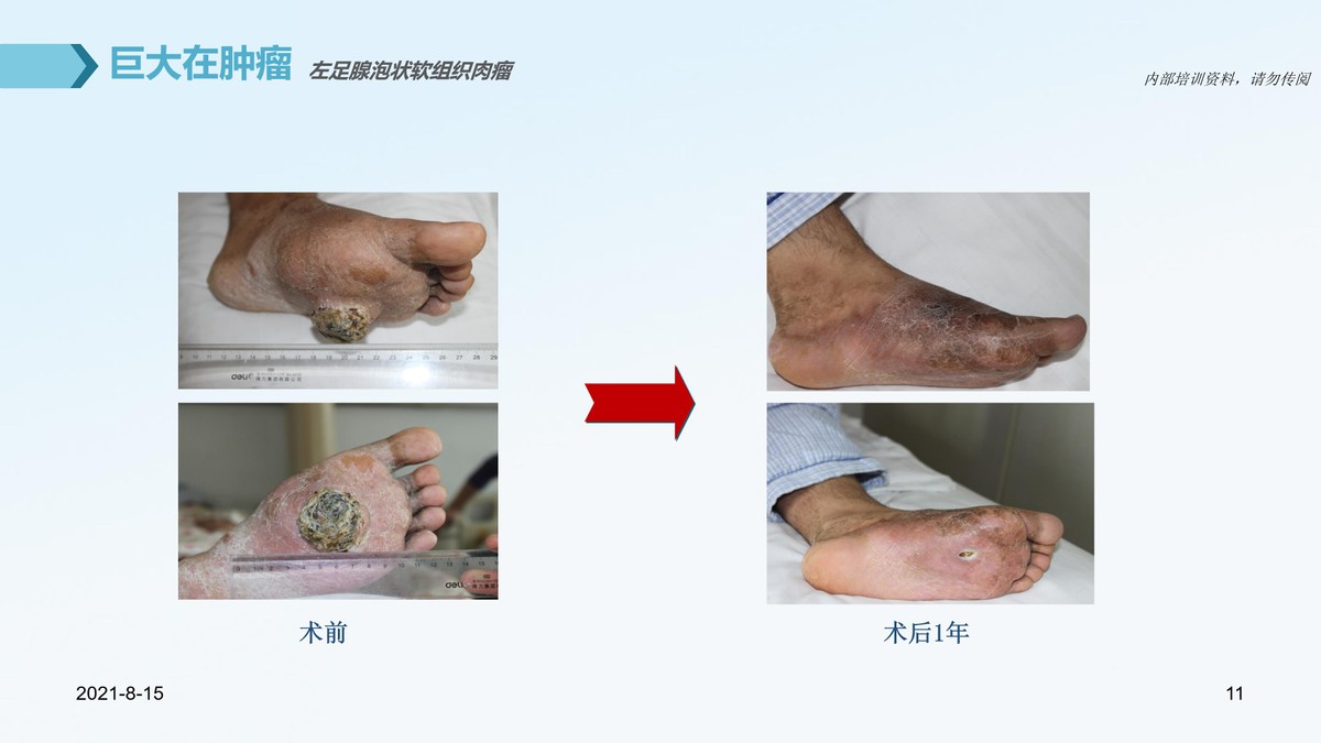 氩氦刀适合早期的肿瘤的切除么,氩氦刀肿瘤治疗新方法