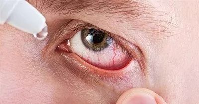 干眼症可以彻底治愈吗,干眼症能彻底治好吗