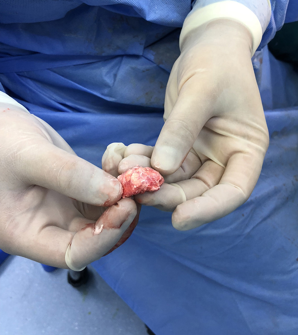 深圳哪家医院痛风石最好,正康骨科痛风