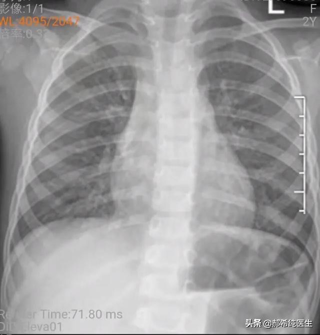 小儿肺炎怕脑炎,儿童肺炎怕吗