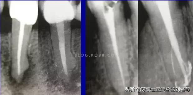 根管治疗难点与解决方案,根管治疗牢固吗