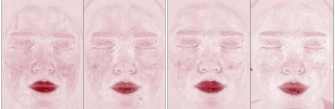 敏感肌脸上高原红怎么去掉,敏感肌高原红如何治疗