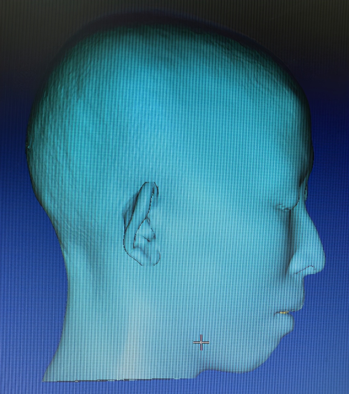 唇形不好看怎么矫正脸型,唇形状不好如何矫正