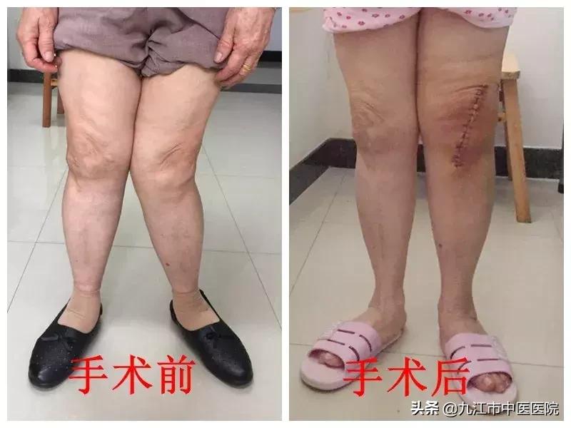 膝外翻畸形,膝外翻畸形伴屈曲畸形