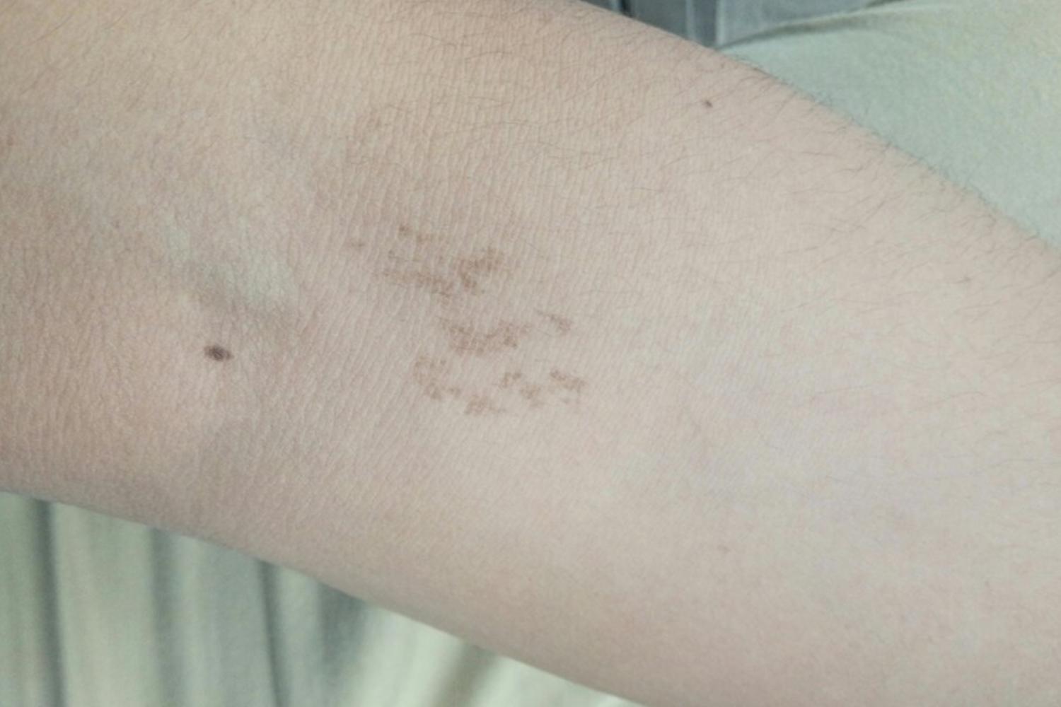 面部长胎记的小孩图片,婴儿面部巨型胎记