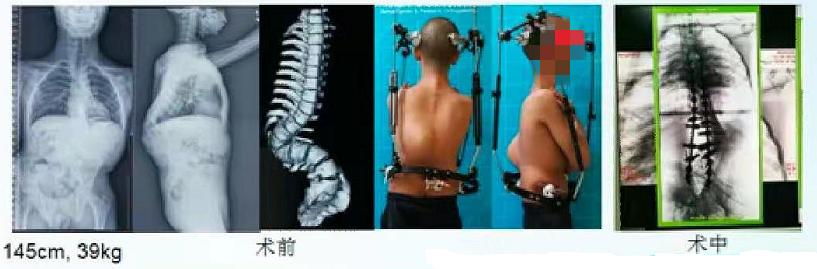 成人脊柱畸形矫形策略是什么,脊柱畸形医疗救治