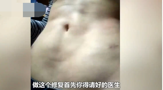 腰部抽脂塑身,女生为了变美去抽脂