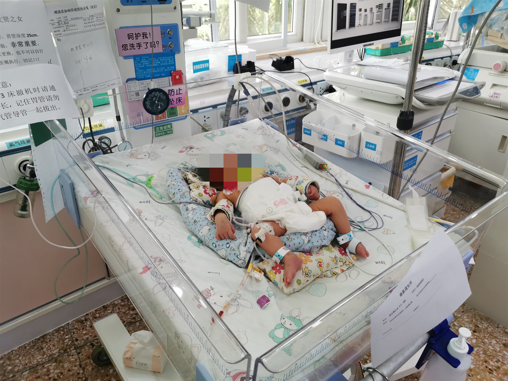 心疼！出生2天早产儿腹胀如包子生命垂危，医生打开腹...