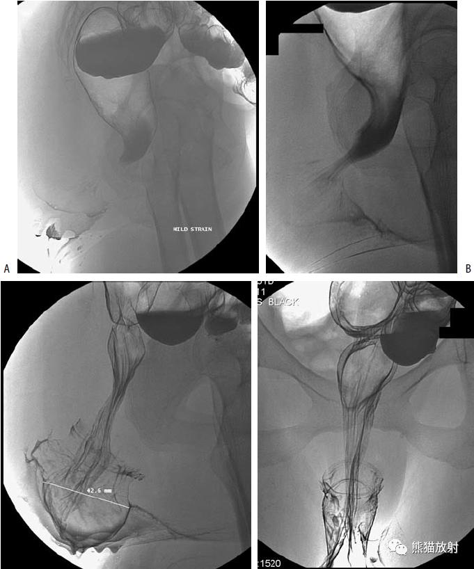 腹部影像图片大全,乙状直肠疼痛位置图片