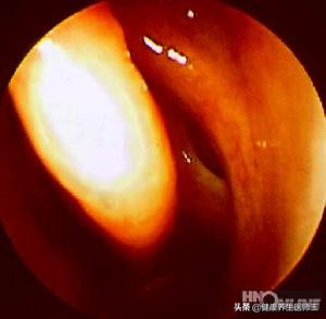 健康之道治鼻炎,急性鼻炎的图片