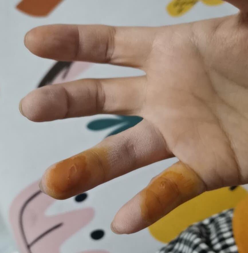 有被宠物狗咬了得狂犬病的案例吗,被狗咬伤狂犬病发作能治好吗