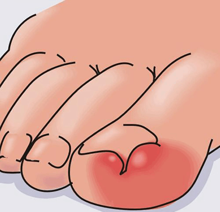 甲沟炎是因为不剪指甲嘛,甲沟炎自愈的十大方法儿童