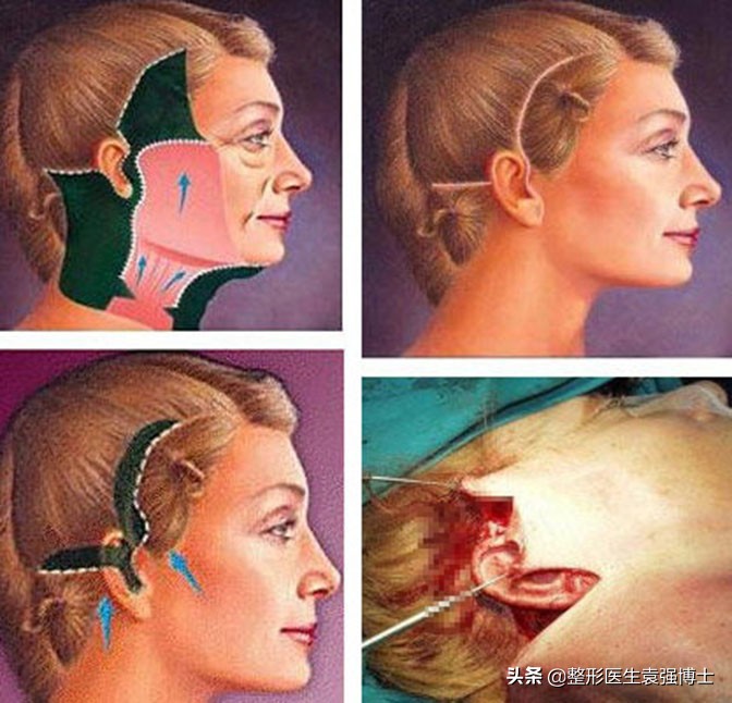 拉皮手术的四大优势,拉皮手术热议