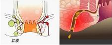 门诊肛瘘,病例分析肛瘘