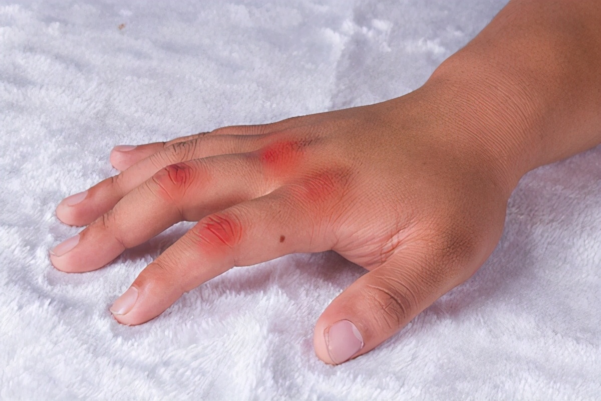 痛风的五个真相让你少走弯路,痛风吃什么才有帮助