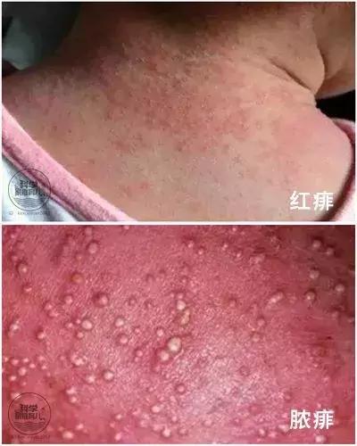 小儿麻疹两天疹子就没有了好不好,小孩荨麻疹最怕三个土方法