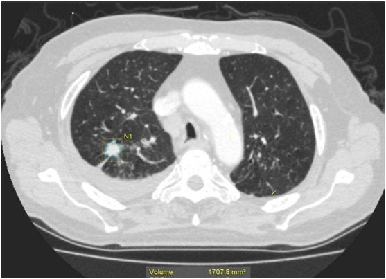 感冒以后做ct发现肺部小结节,乳腺癌术后复查ct发现肺部小结节