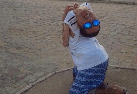 男子身体弯曲180度现状,男子头颅畸形