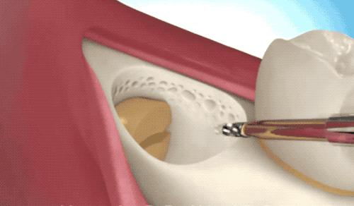 拔智齿是怎么算收费的,拔智齿是按智齿个数收费吗